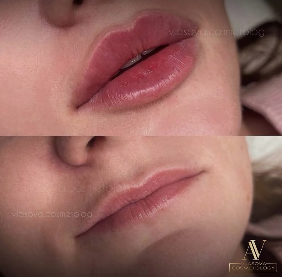 Lip filler before and after