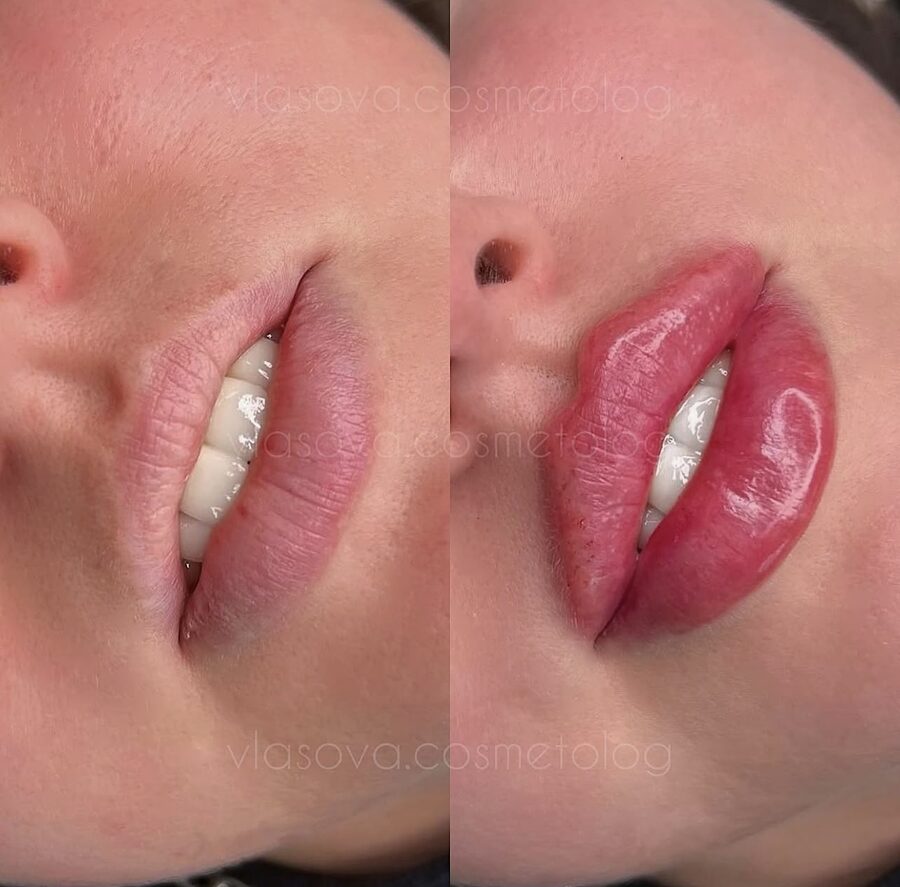Lip enhancement before and after