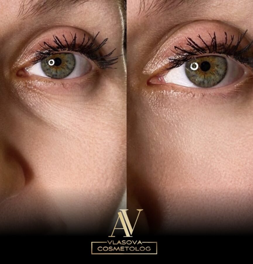 Under-eye rejuvenation before and after