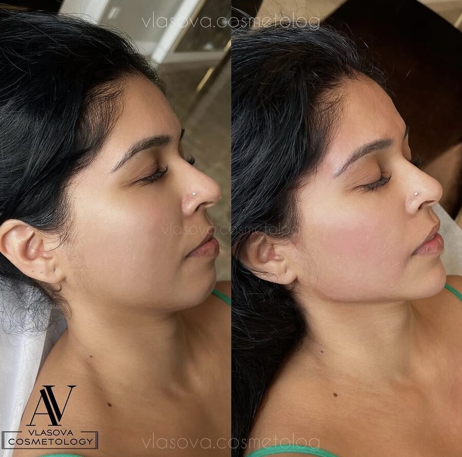 Profile balancing before and after