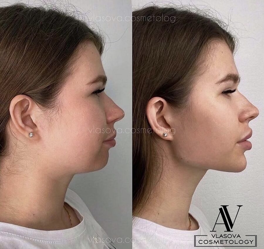 Chin and jawline before and after