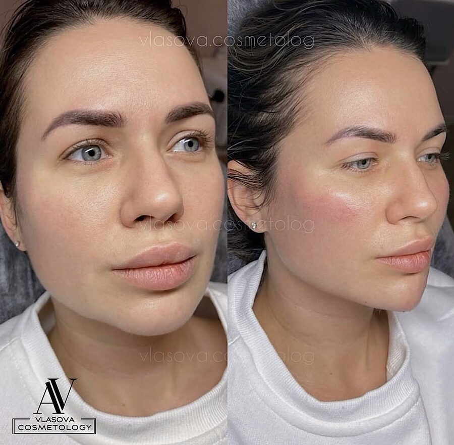 Full face rejuvenation before and after