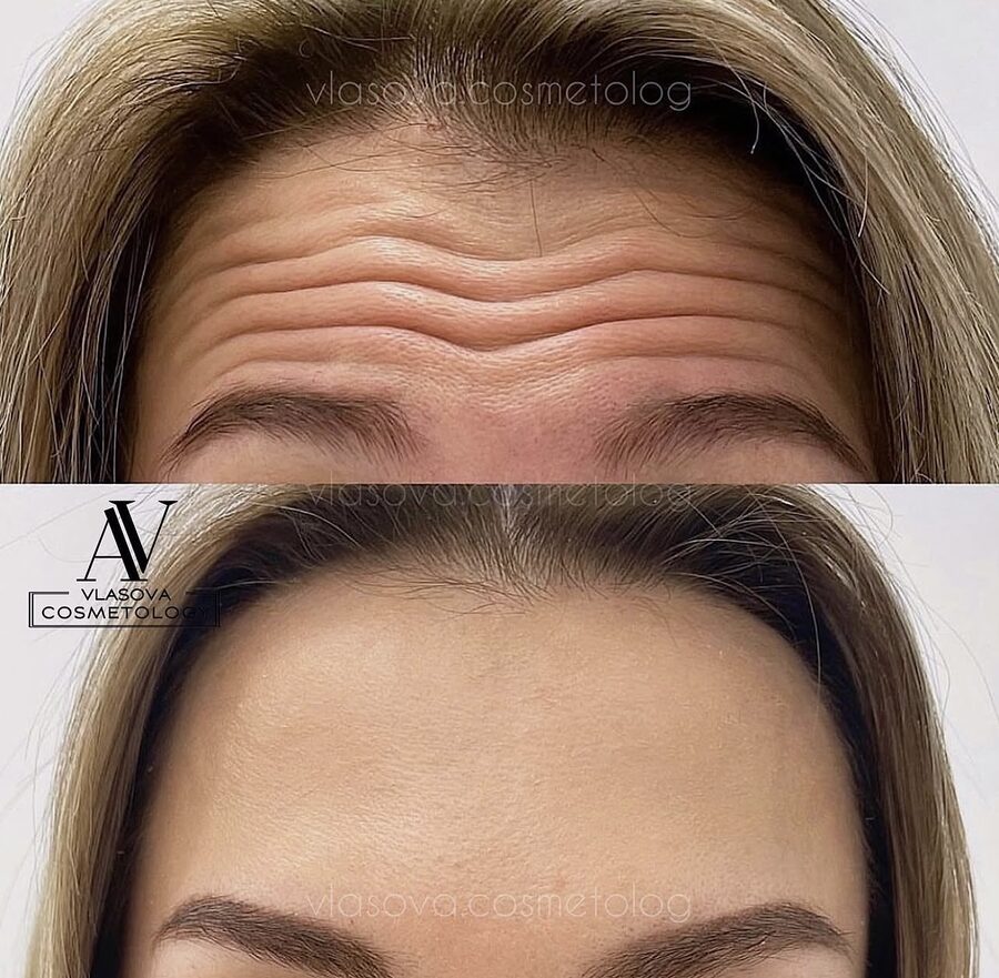 Botox — 2 Areas &mdash; before and after
