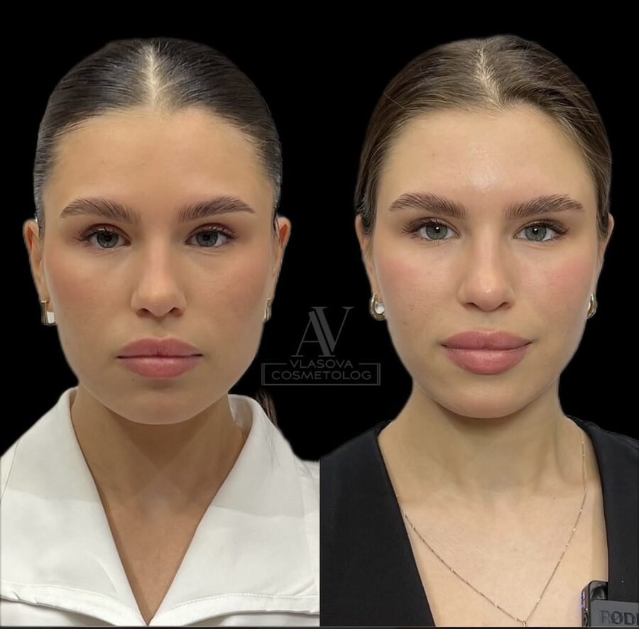 Botox Full Face &mdash; before and after