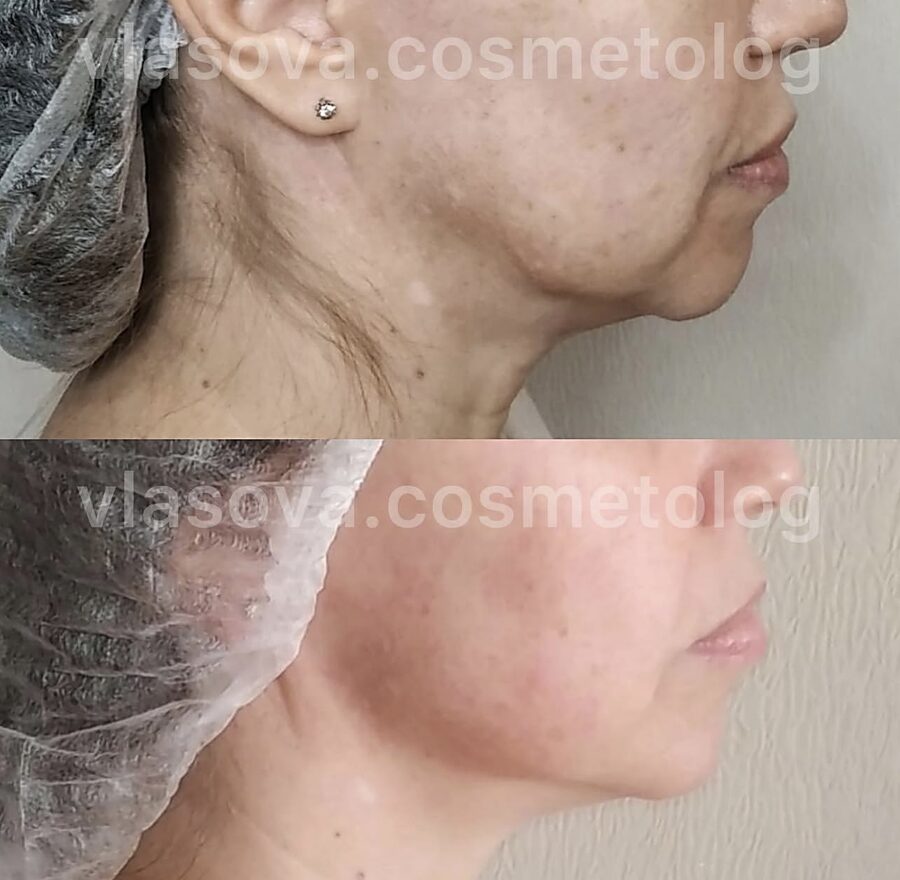 Botox Neck (Platysma) &mdash; before and after