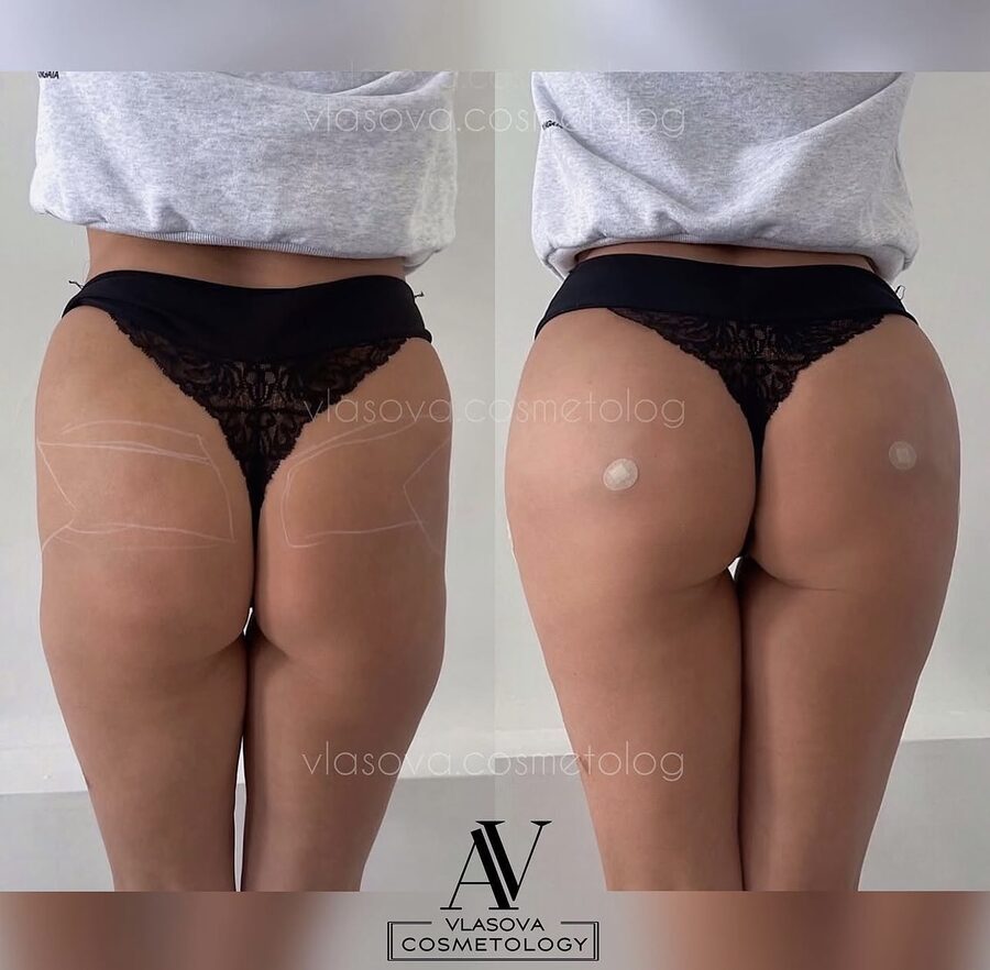 Buttocks 200 ml &mdash; before and after