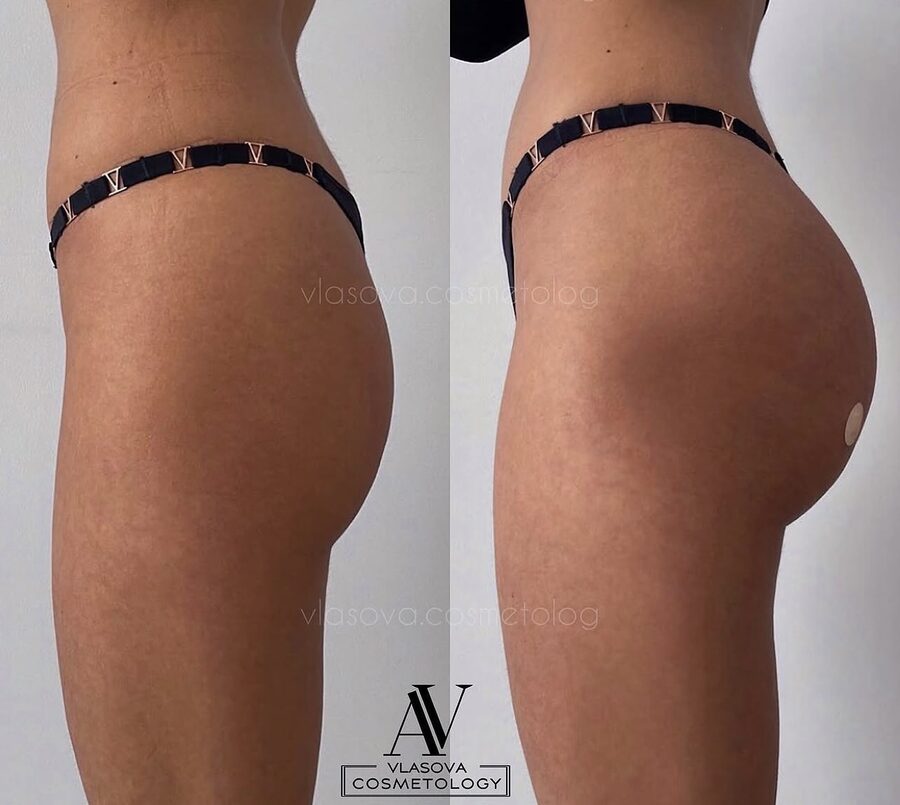 Buttocks 300 ml &mdash; before and after