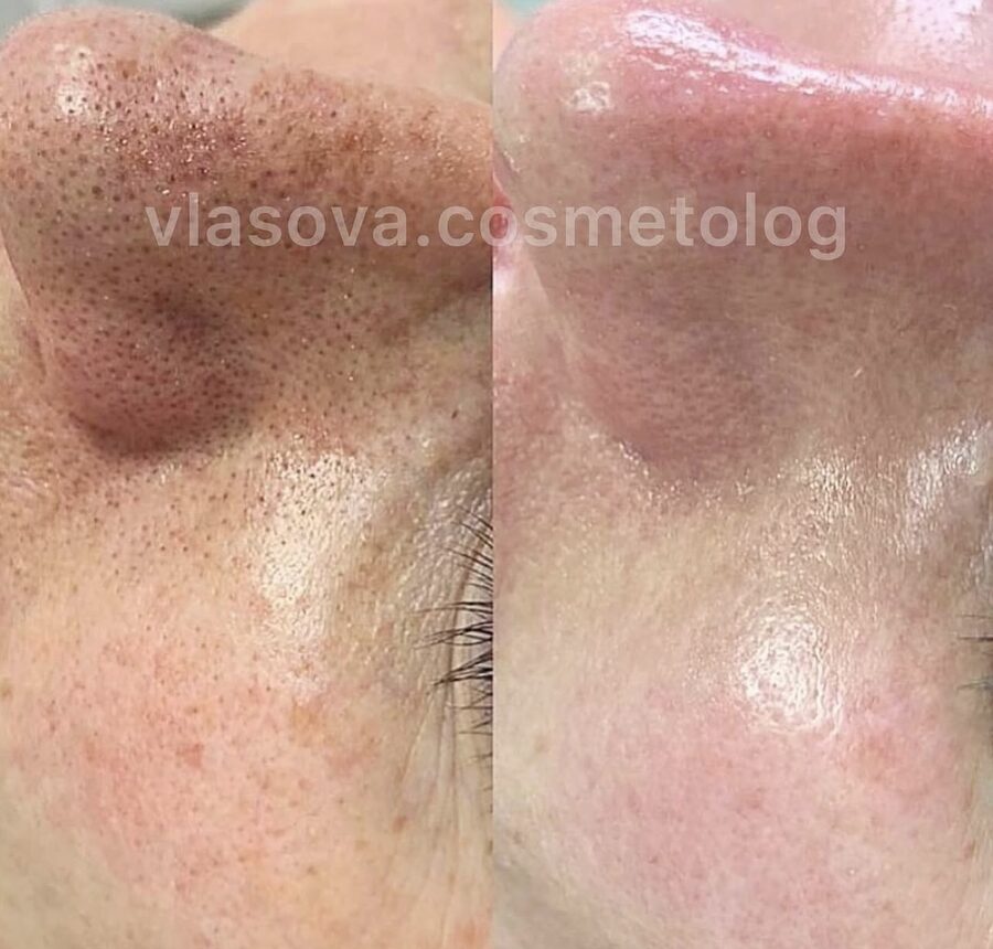 Deep Cleansing Facial + Peel &mdash; before and after