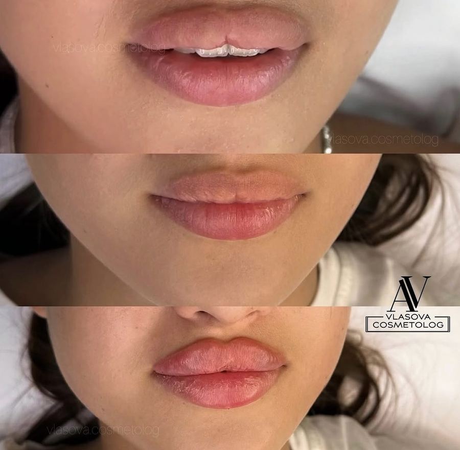 Filler Dissolution — before and after