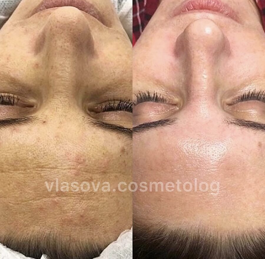 Exosome Microneedling &mdash; before and after