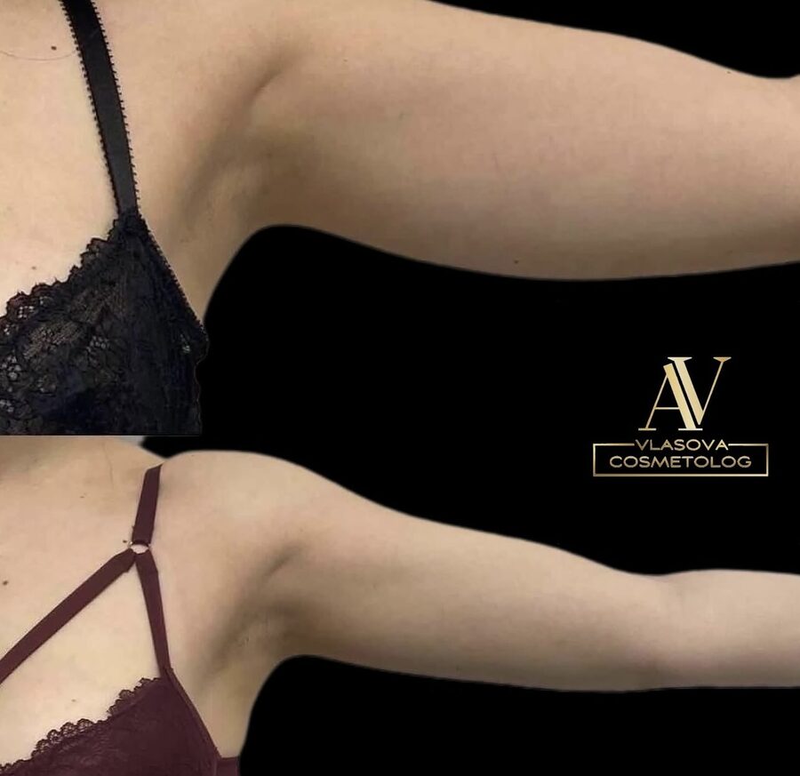 Fat Dissolving (Face or Body) &mdash; before and after