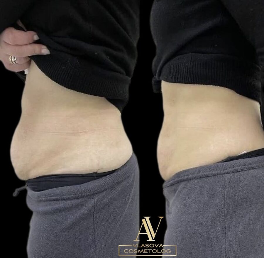 Fat Dissolving (Face or Body) &mdash; before and after