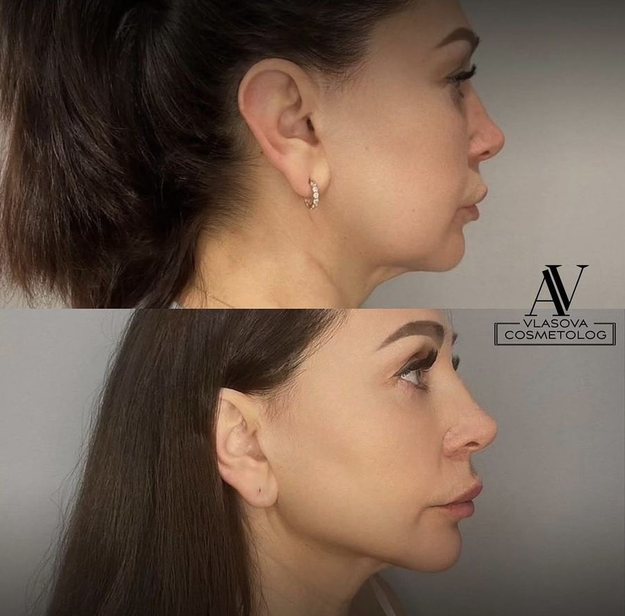 3 Areas — any three zones — before and after