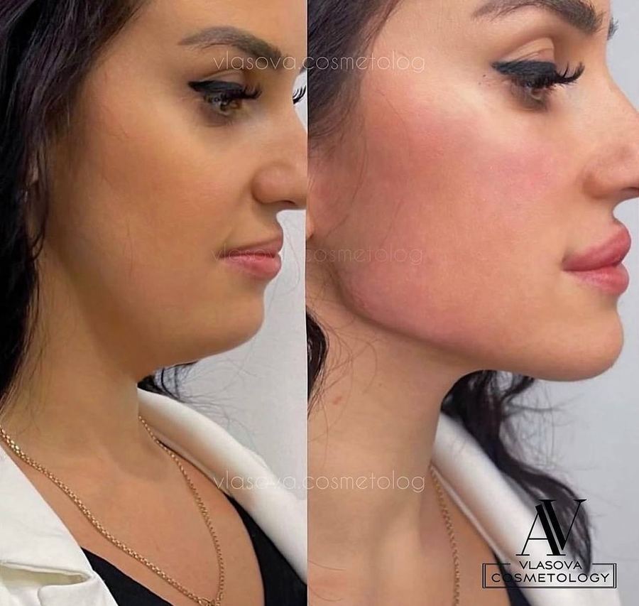 Full Face Premium — Juvederm / Stylage — before and after