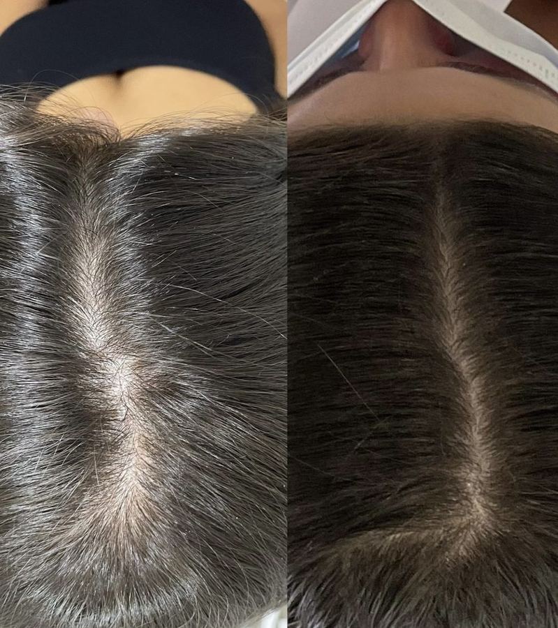 Hair Mesotherapy — before and after
