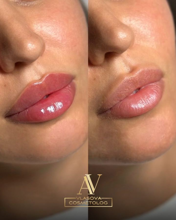 Lip Filler — Juvederm 0.5 ml / Belotero — before and after