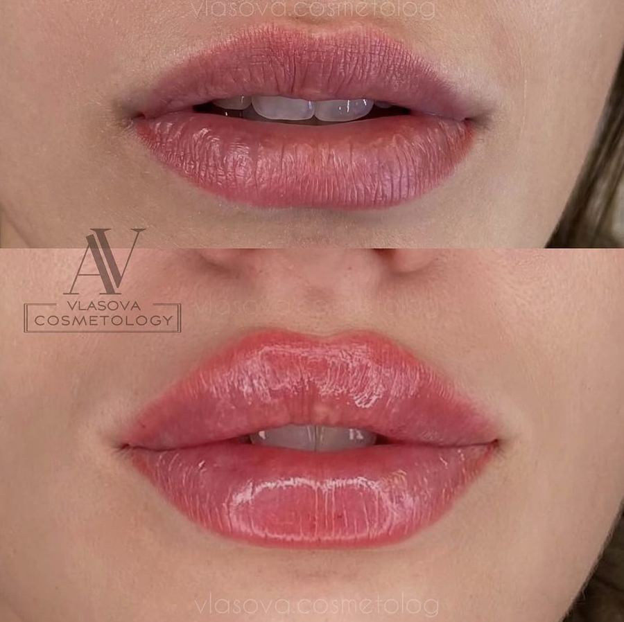Lip Filler — Juvederm 1 ml — before and after