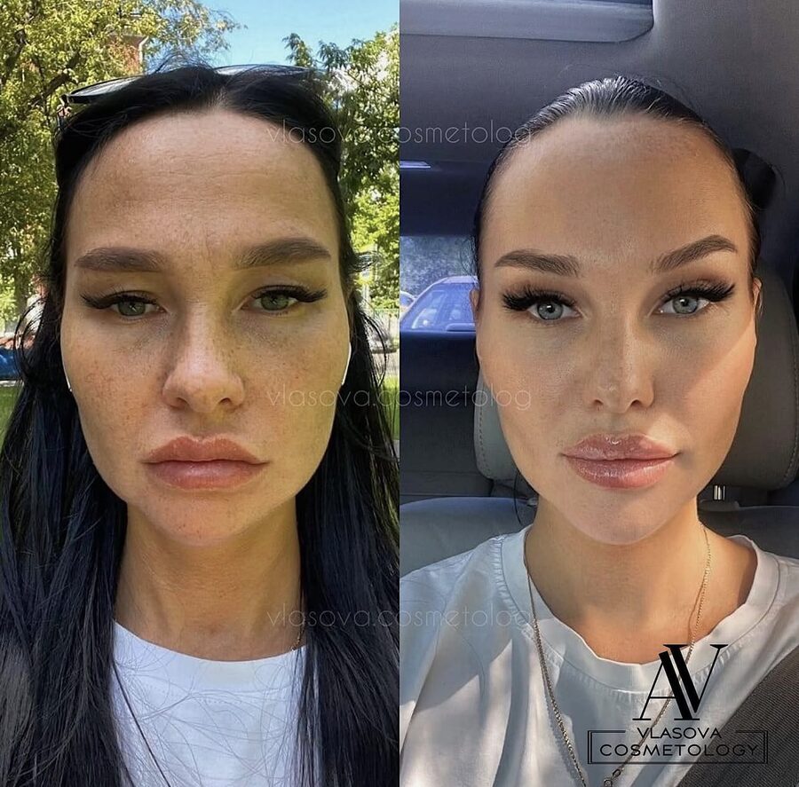 Masseter (Jaw Slimming) &mdash; before and after