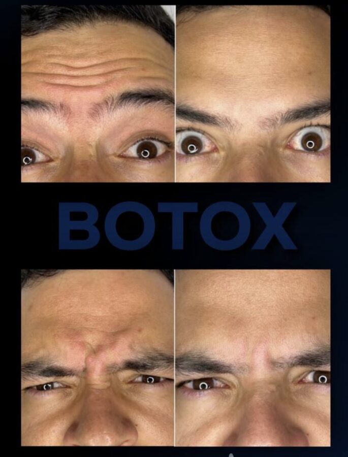 Men Botox — 2 Areas &mdash; before and after