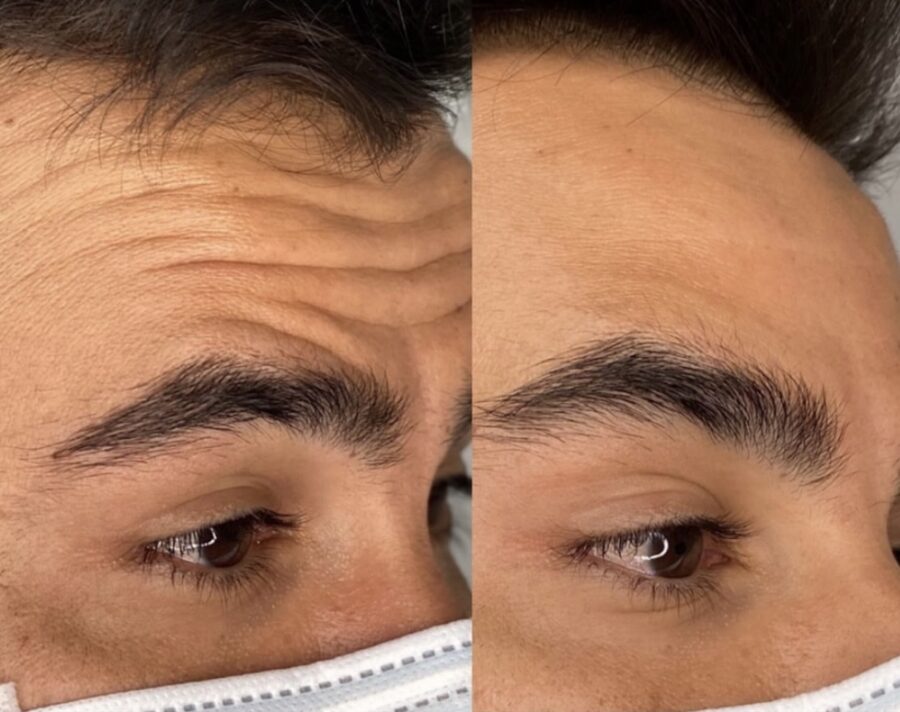Men Botox — 3 Areas &mdash; before and after