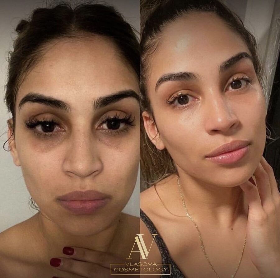 Mesoeye &mdash; before and after