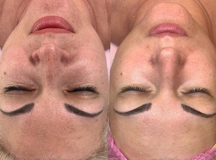 Microneedling + Booster — before and after
