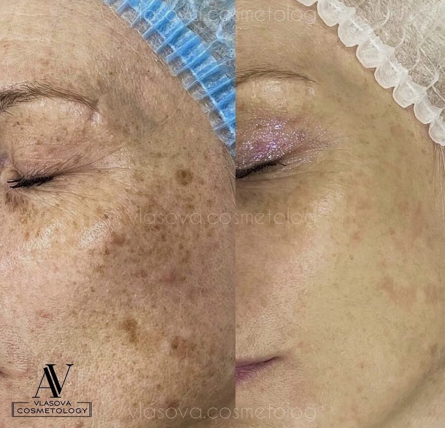Pigmentation Treatment &mdash; before and after