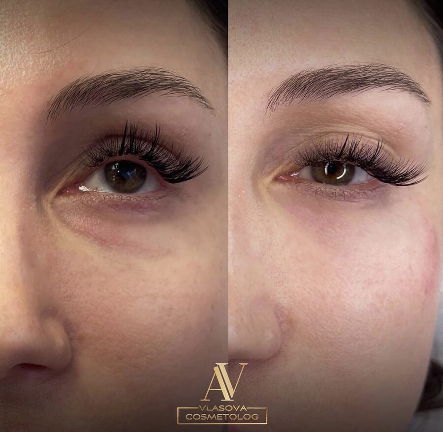 Under Eyes &mdash; before and after