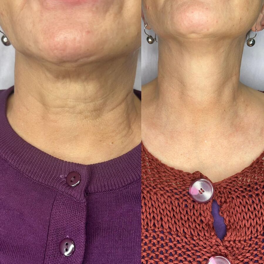 Full Face & Neck &mdash; before and after