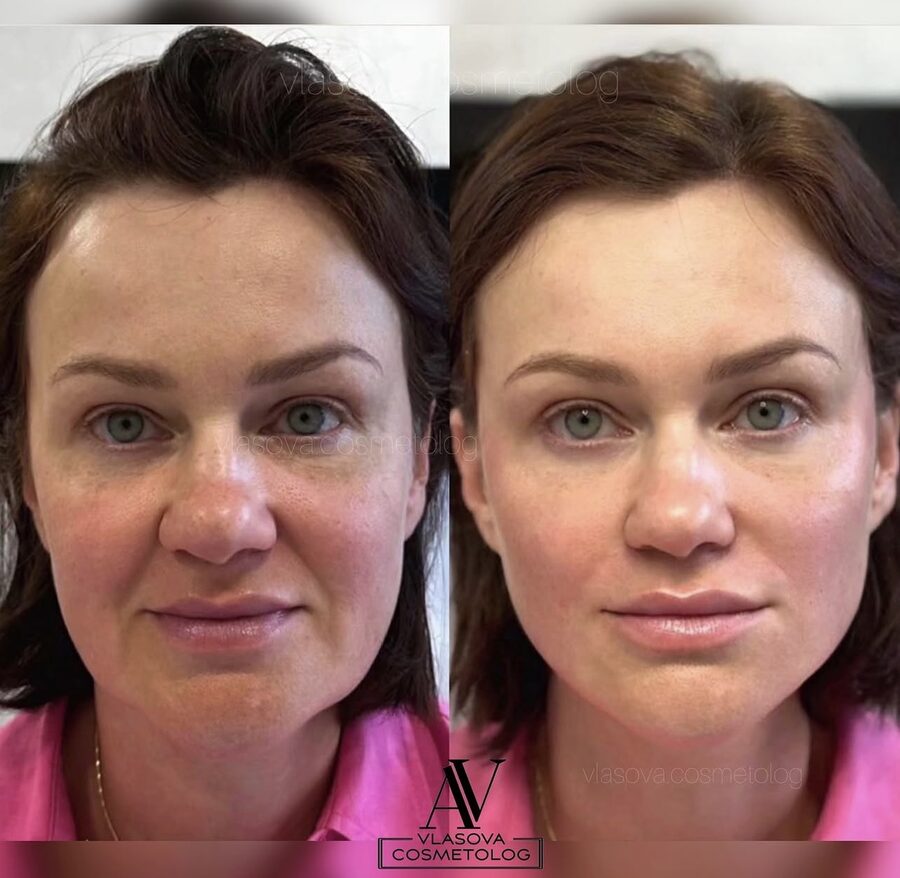 Full Face & Neck &mdash; before and after