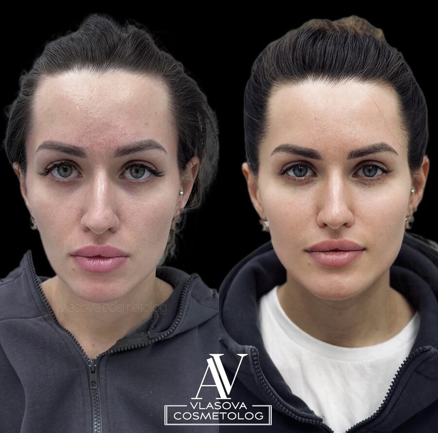 Full Face &mdash; before and after