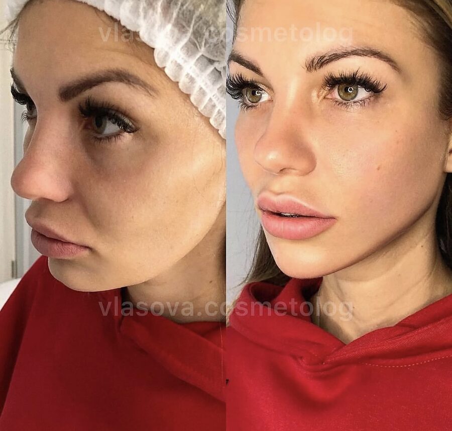 Profhilo &mdash; before and after