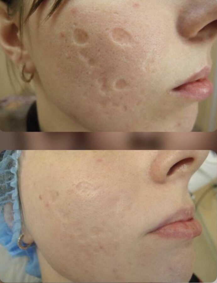 Scar correction &mdash; before and after