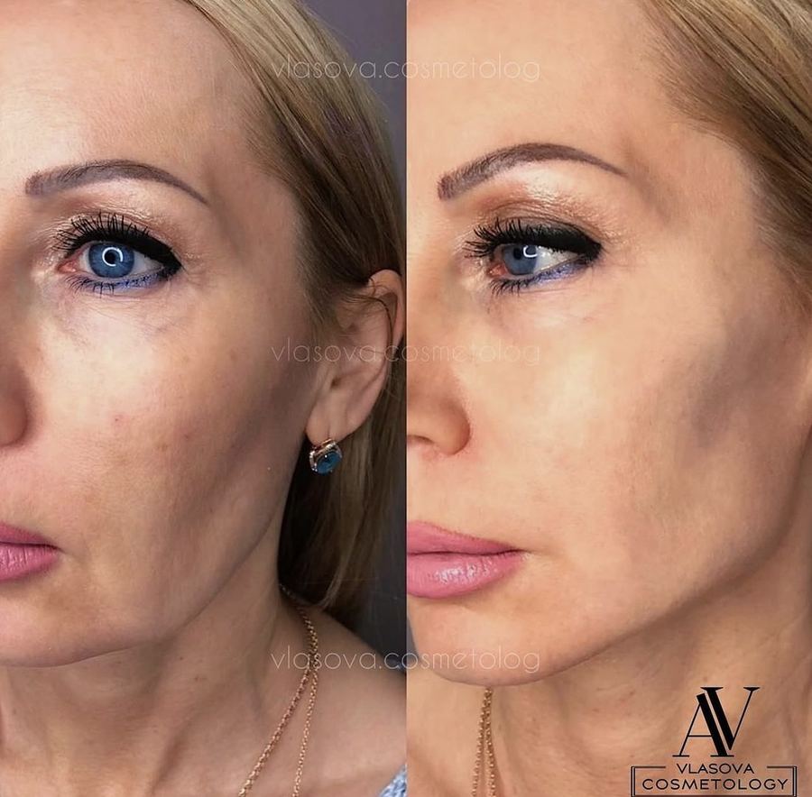 Skin Botox — before and after