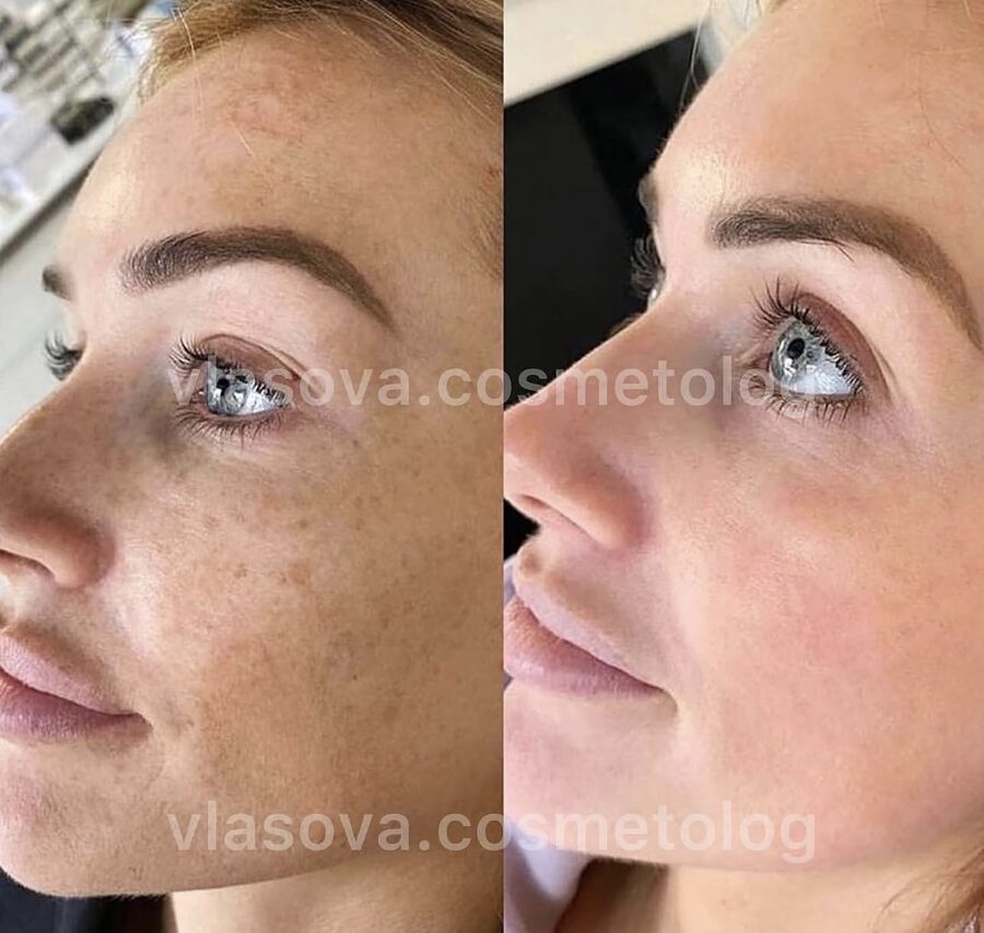 Skin Booster / Mesotherapy &mdash; before and after