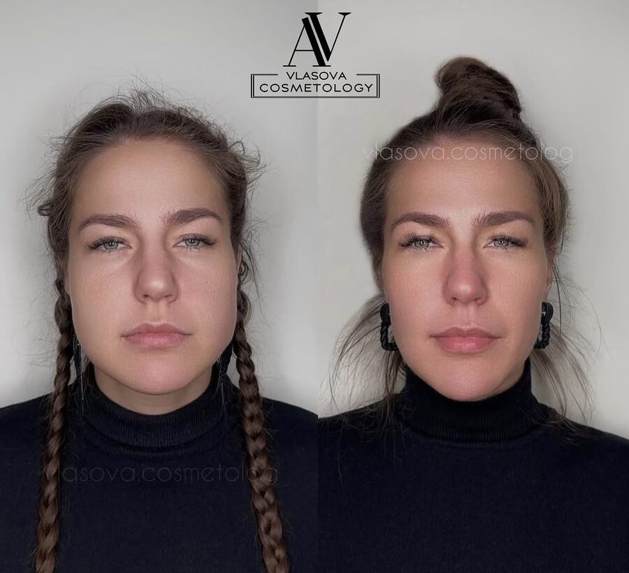 Slim Face &mdash; before and after