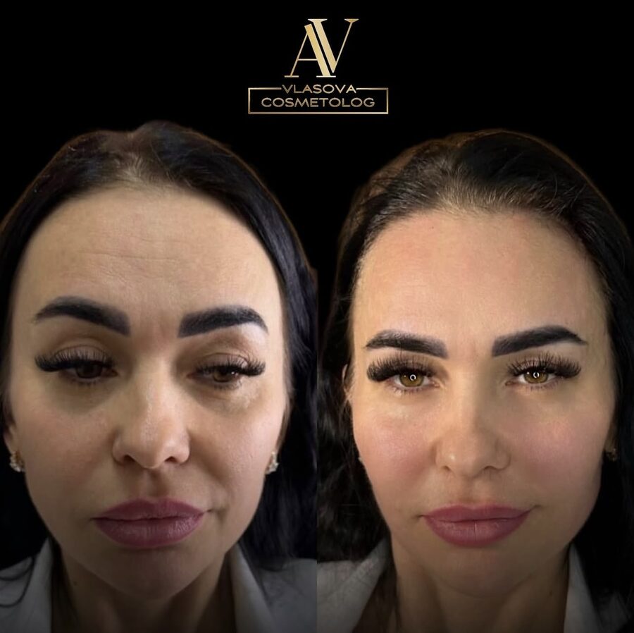 Thread Lift (Full Face) &mdash; before and after