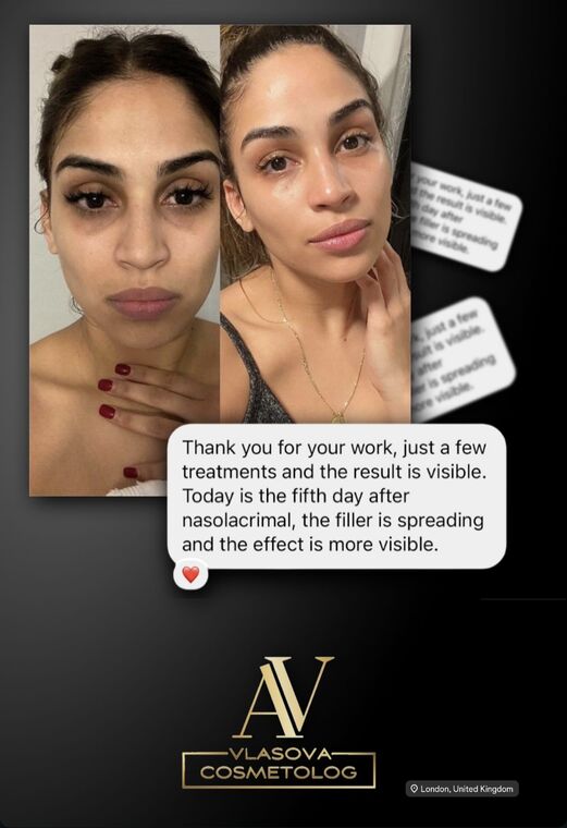 Client review for Tear trough filler
